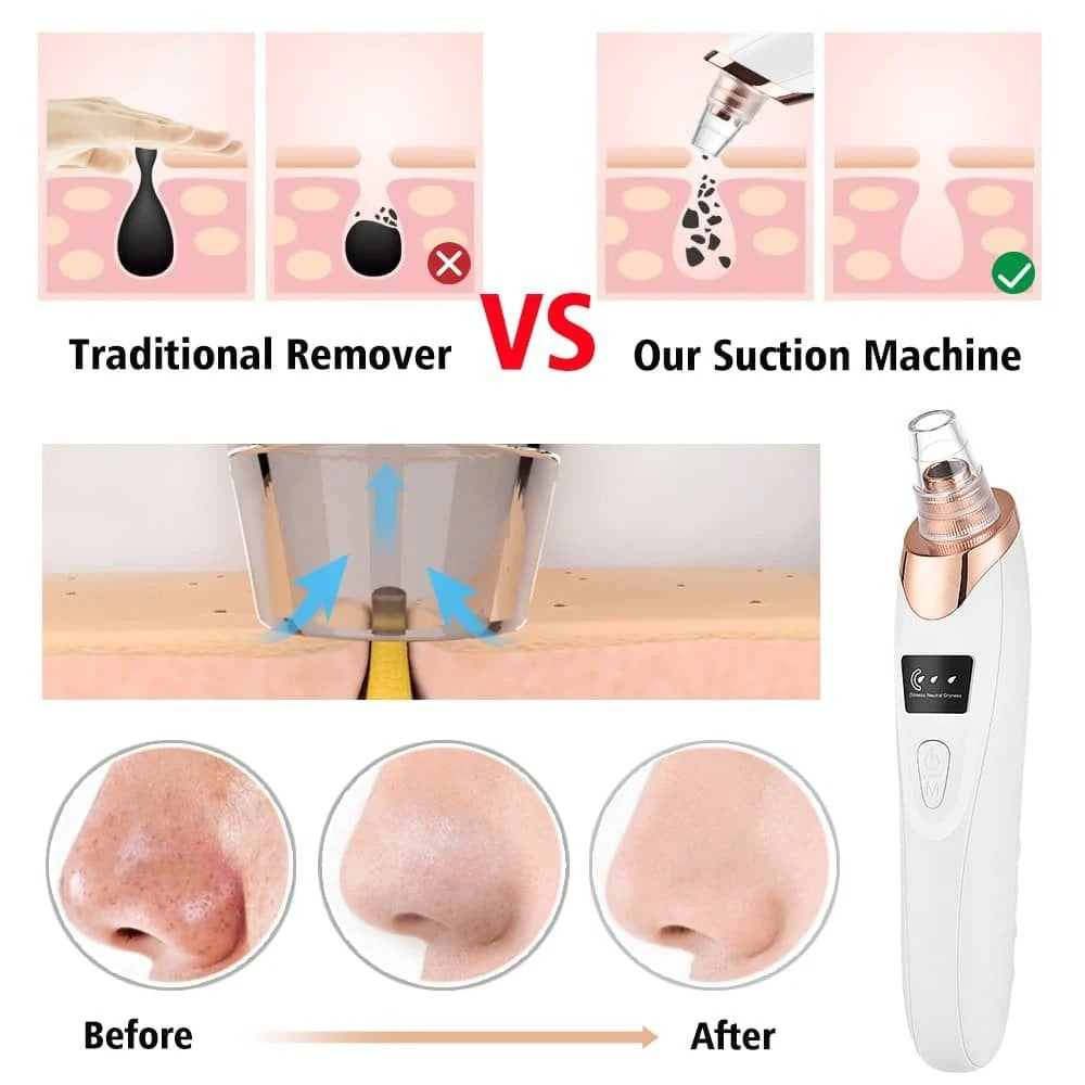 Blackhead Remover Vacuum.